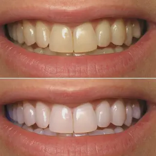 /img/30492-whitening-gums-staining-foods.webp