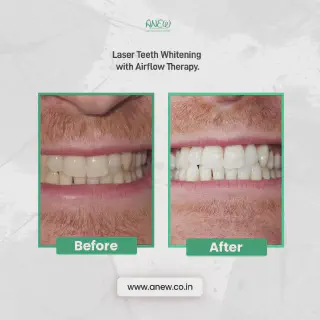 /img/30493-healthy-teeth-whitening.webp