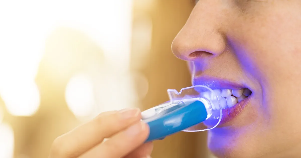 30494 custom tray whitening