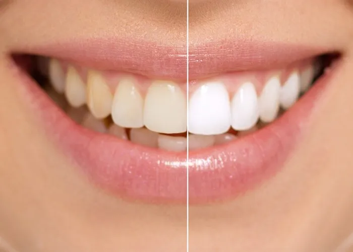/img/30494-healthy-smile.webp