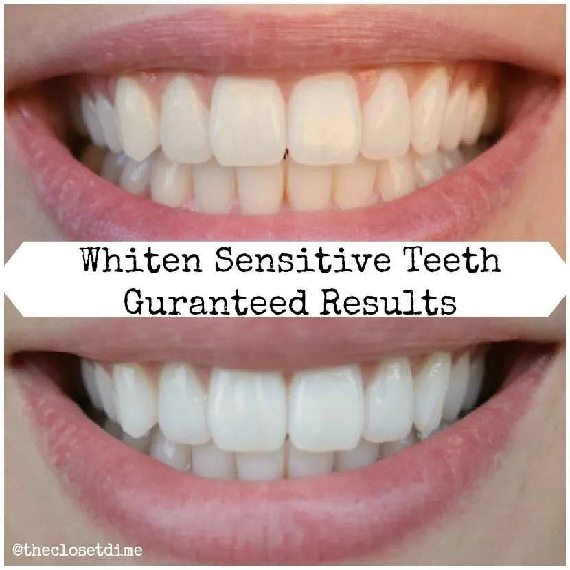 30494 teeth whitening aftercare