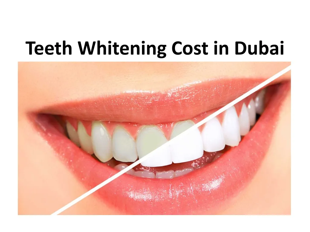 30505 at home teeth whitening kits