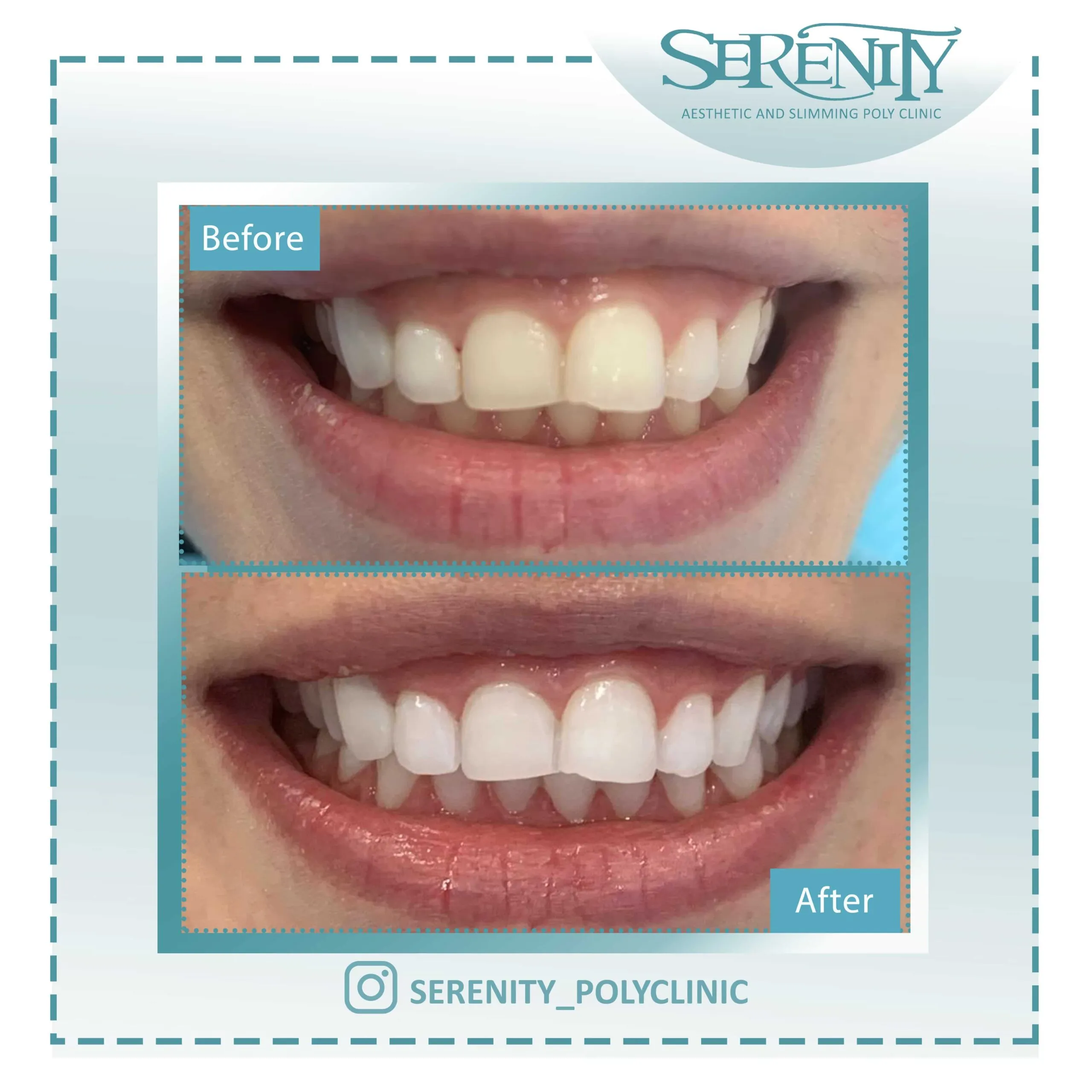 30505 teeth whitening dubai clinic