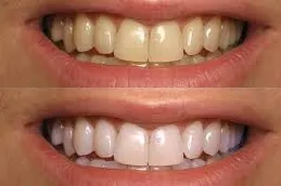 30505 teeth whitening dubai comparison