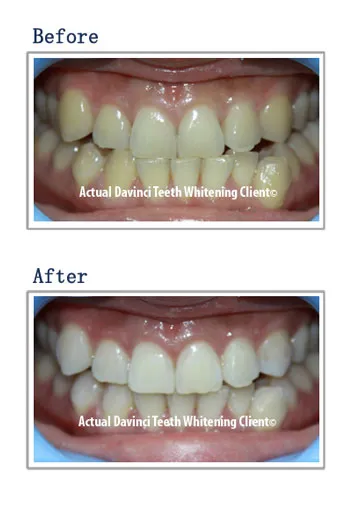 30509 certified teeth whitening professional