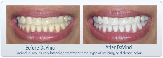 30509 patient satisfaction teeth whitening