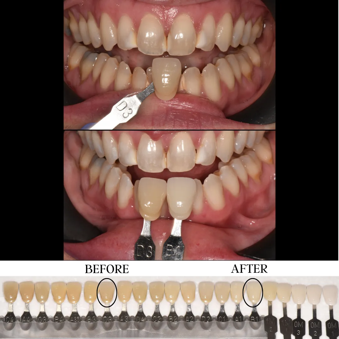 30510 teeth whitening sioux falls sd oral hygiene