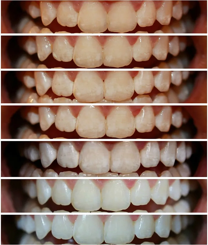 30514 consistent whitening schedule