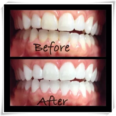 30515 teeth whitening cincinnati 4