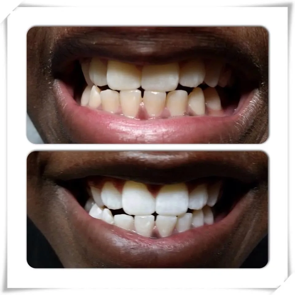 30515 teeth whitening cincinnati 5