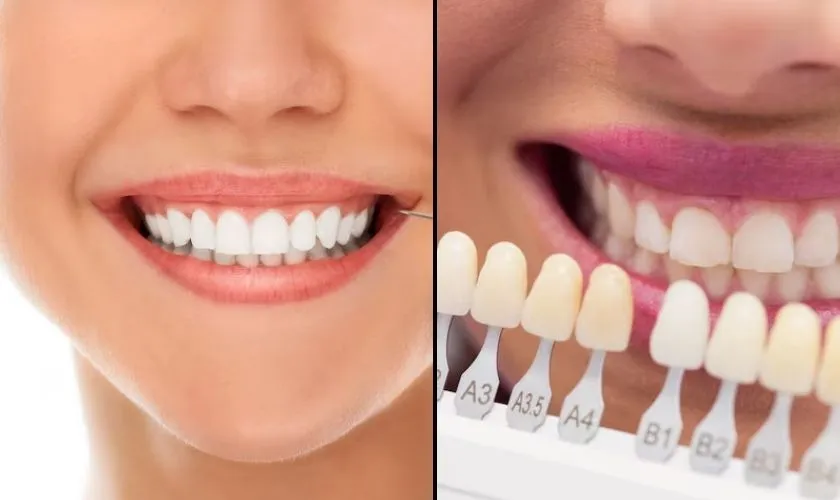 30516 teeth whitening process