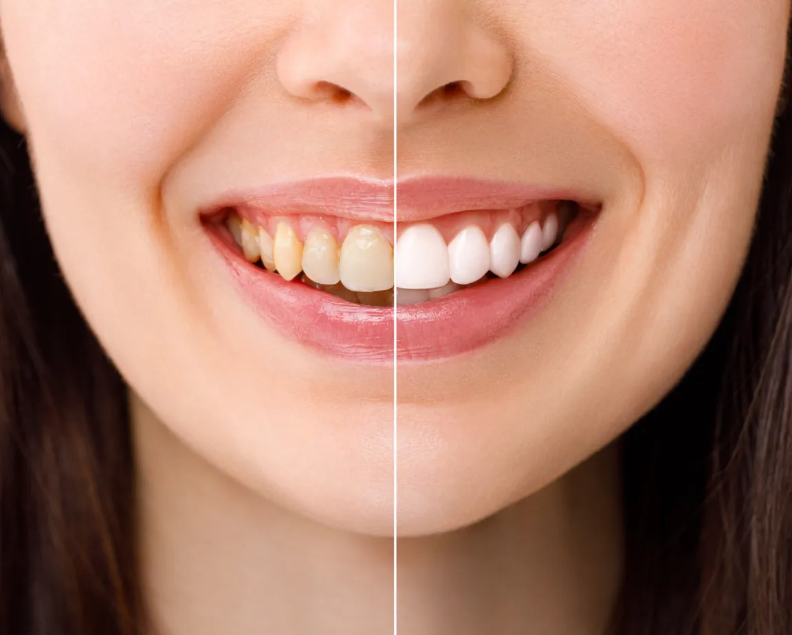 30516 teeth whitening vs veneers overview