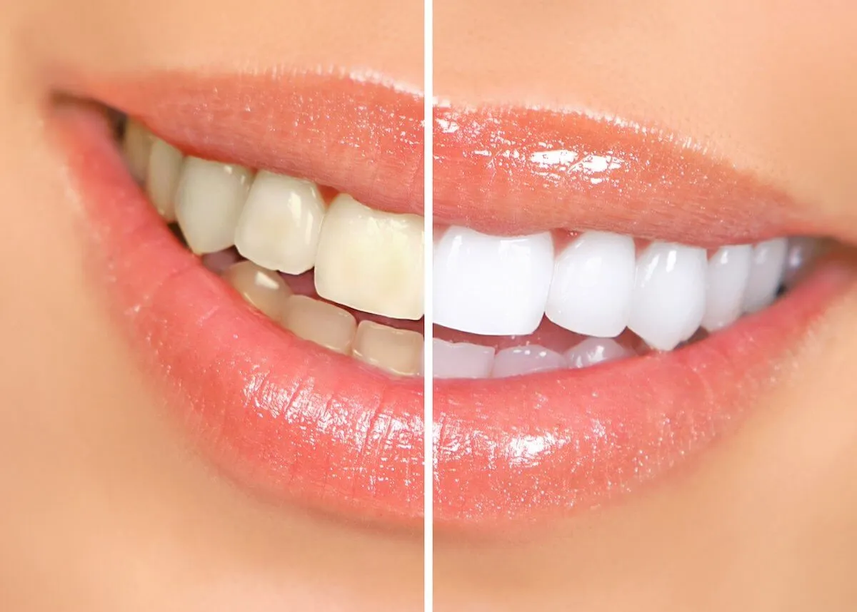 30516 teeth whitening