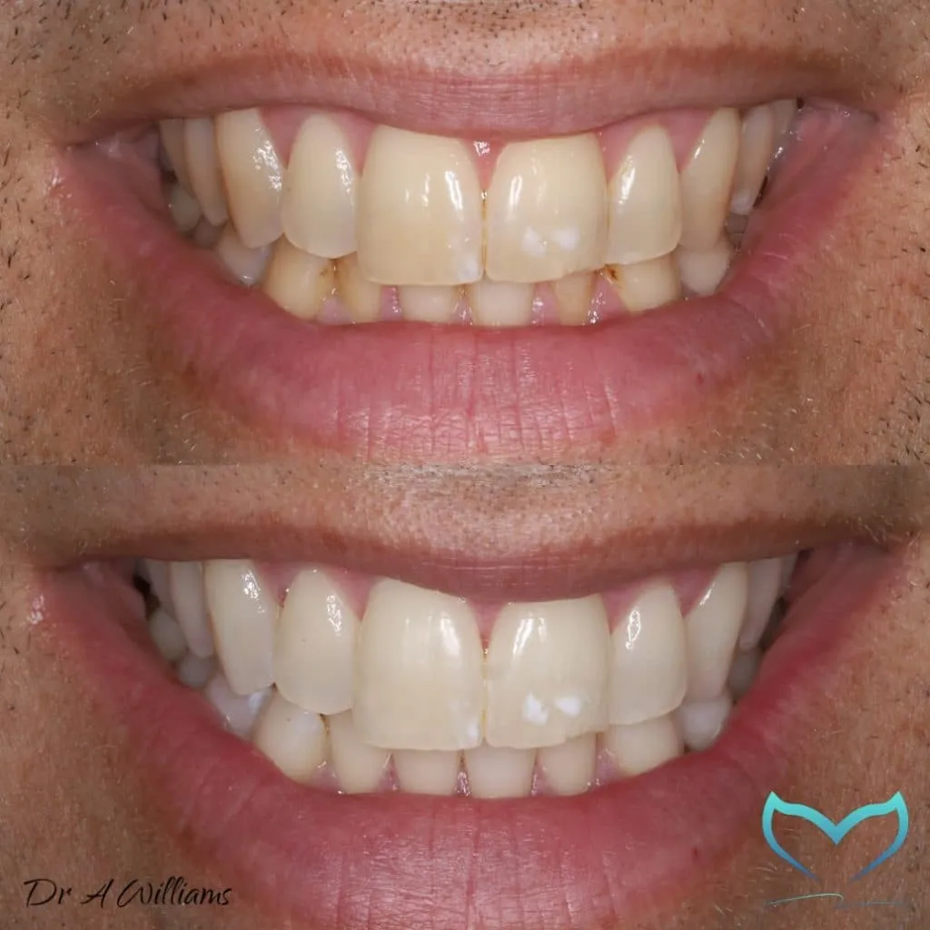 30516 veneers process