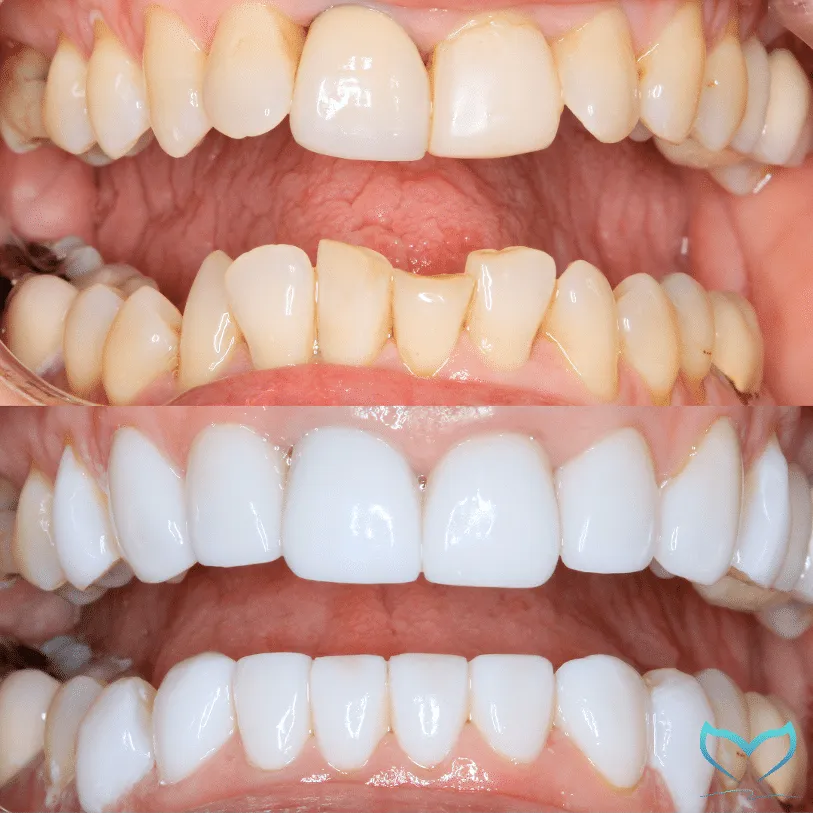 30516 veneers
