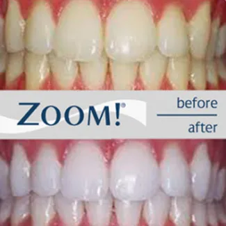 30517 zoom whitening process
