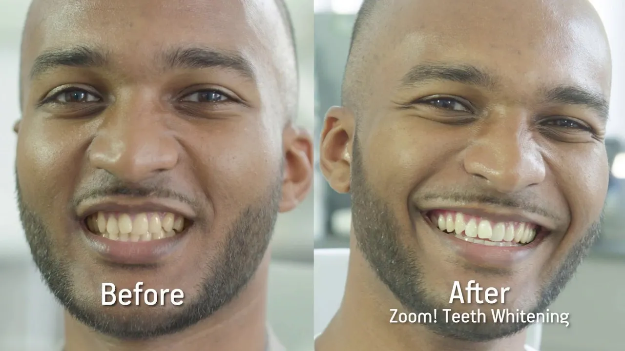 30517 zoom whitening smile
