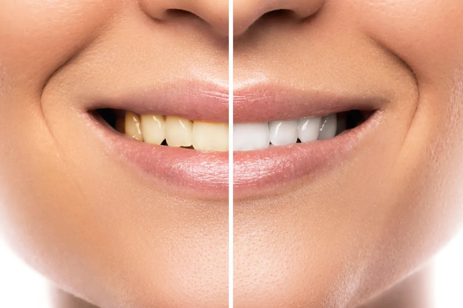 30522 teeth whitening beverly hills ca image2
