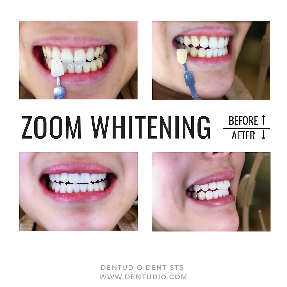 30522 teeth whitening beverly hills ca image4
