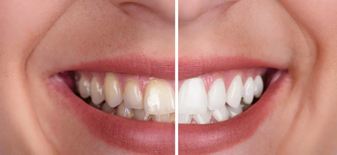 30524 teeth whitening risks intro