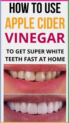 30525 teeth whitening tips