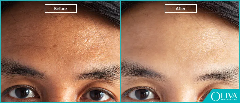 30527 chemical peel treatment