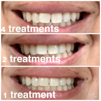 30528 allergic reaction