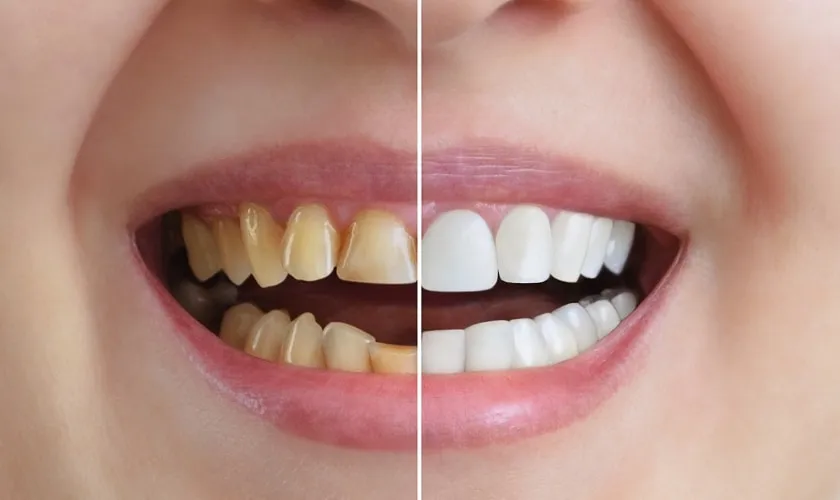 30530 whitening timeline