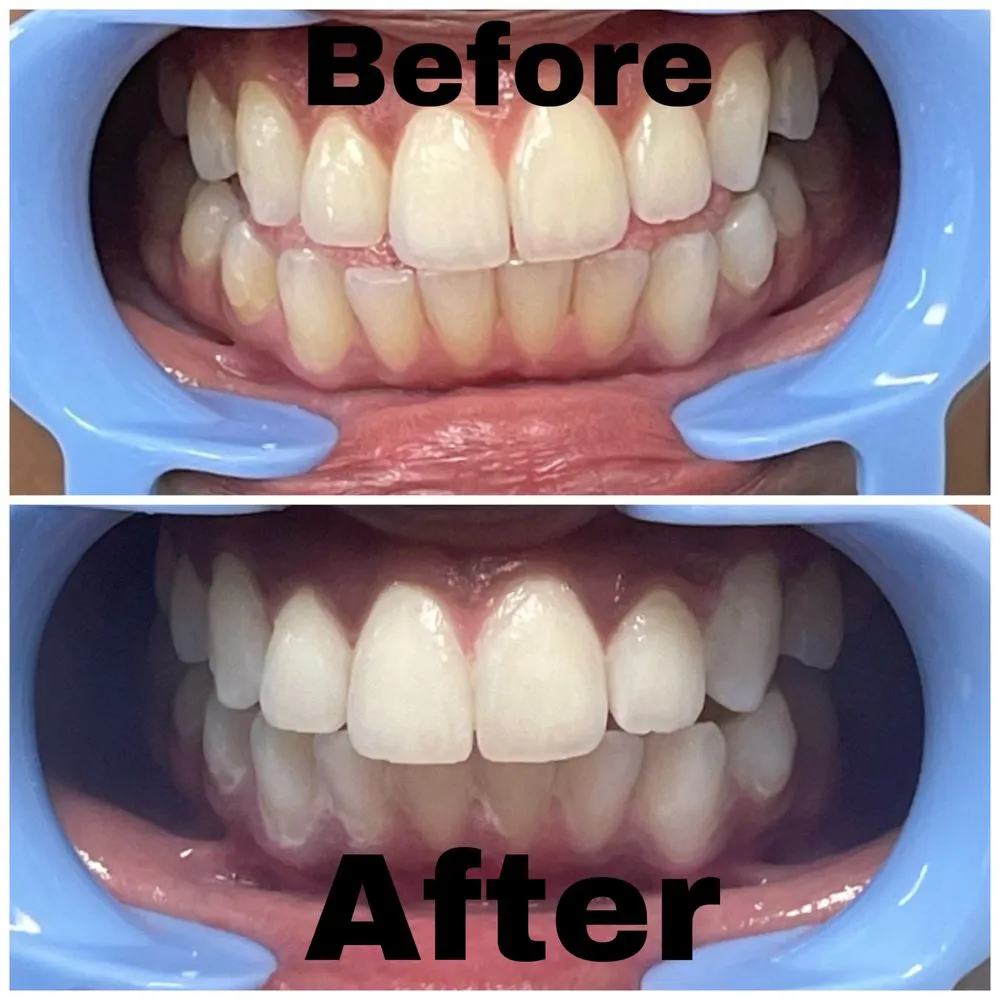 30537 teeth whitening intro