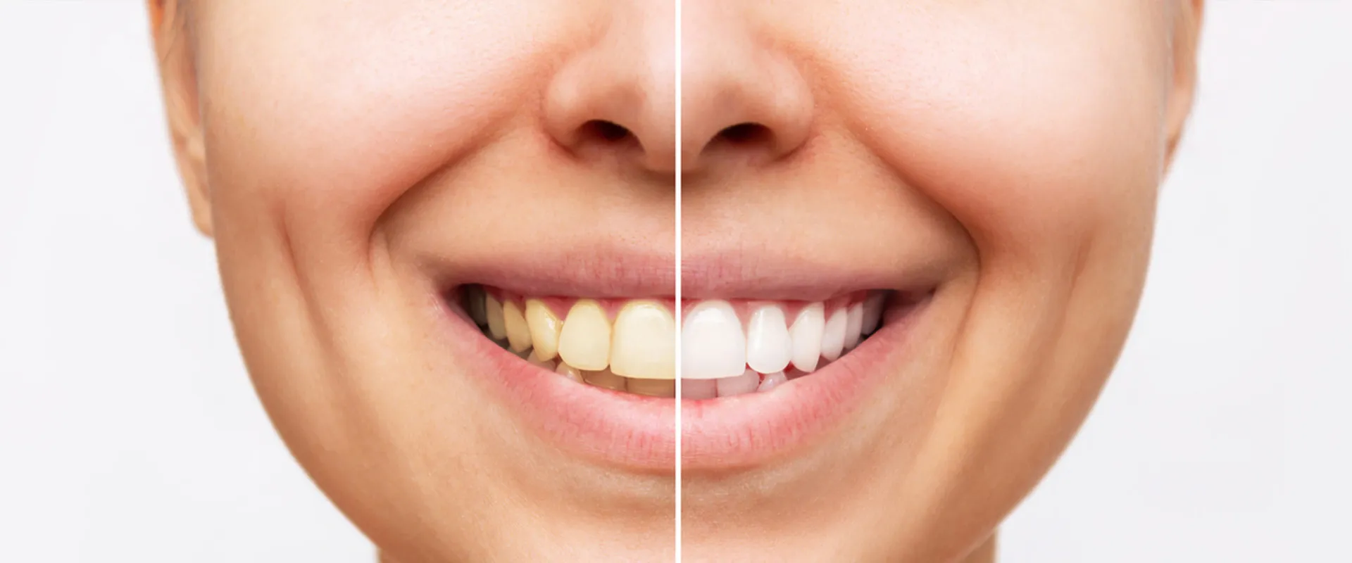 30538 in office whitening