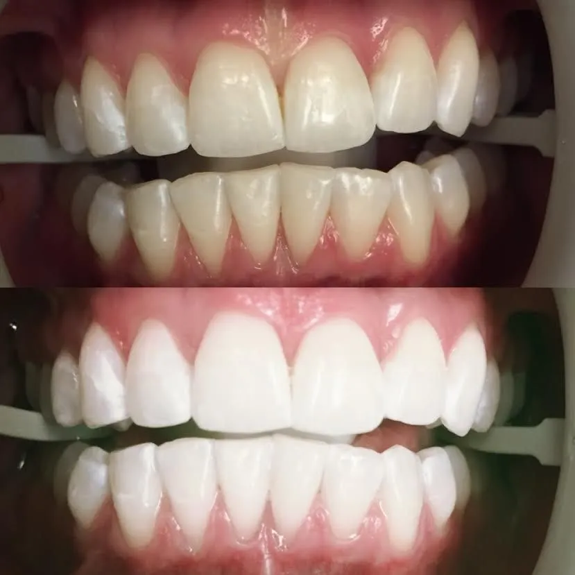 30541 zoom whitening nashville tn procedure