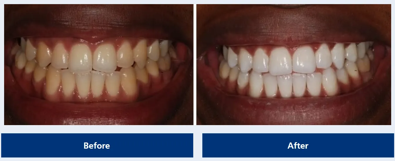 30541 zoom whitening nashville tn results