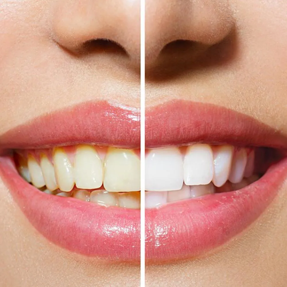 30543 foods staining teeth