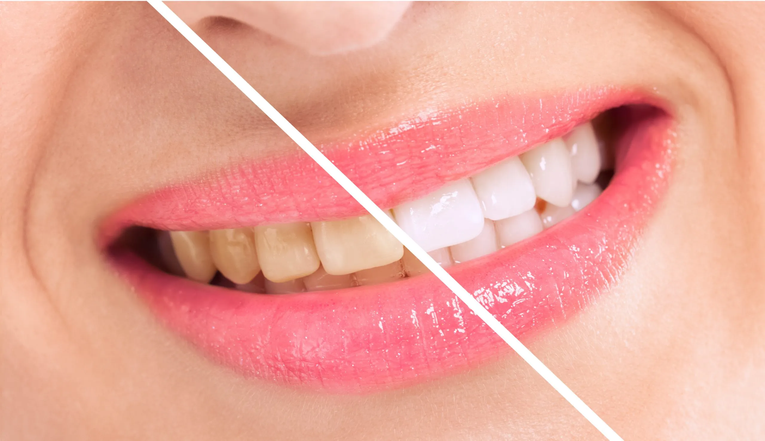 /img/30543-teeth-whitening-sensitivity.webp