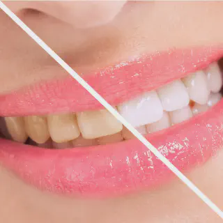 /img/30543-teeth-whitening-sensitivity.webp