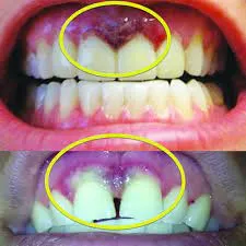 30546 gum inflammation