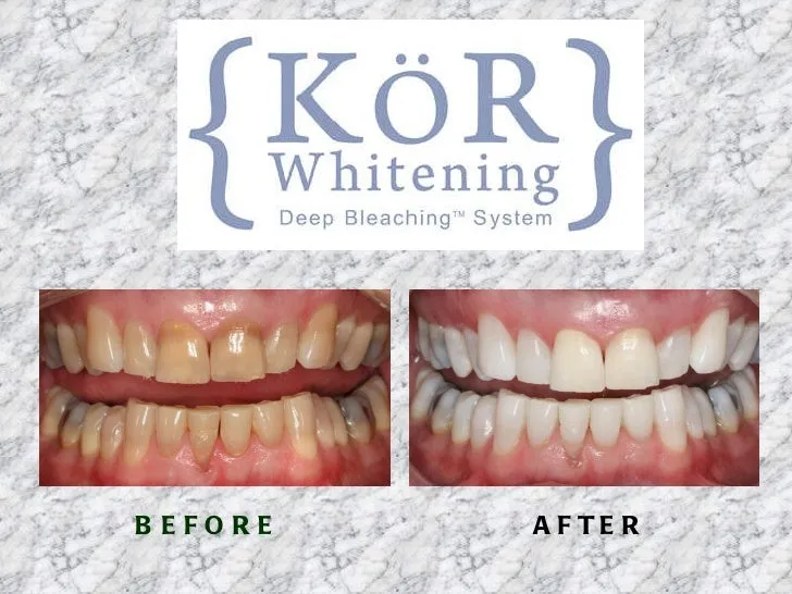 /img/30549-kor-teeth-whitening-results.webp