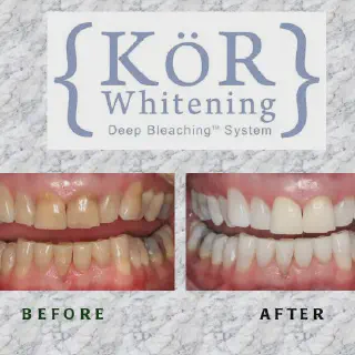 /img/30549-kor-teeth-whitening-results.webp