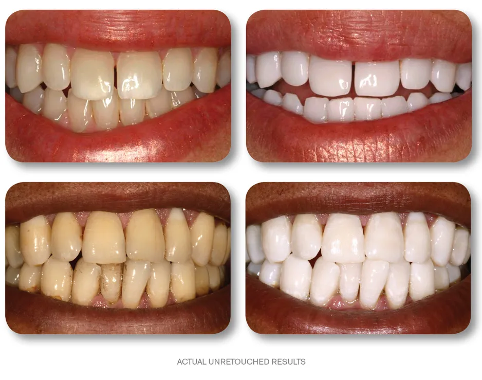 30549 kor whitening tray