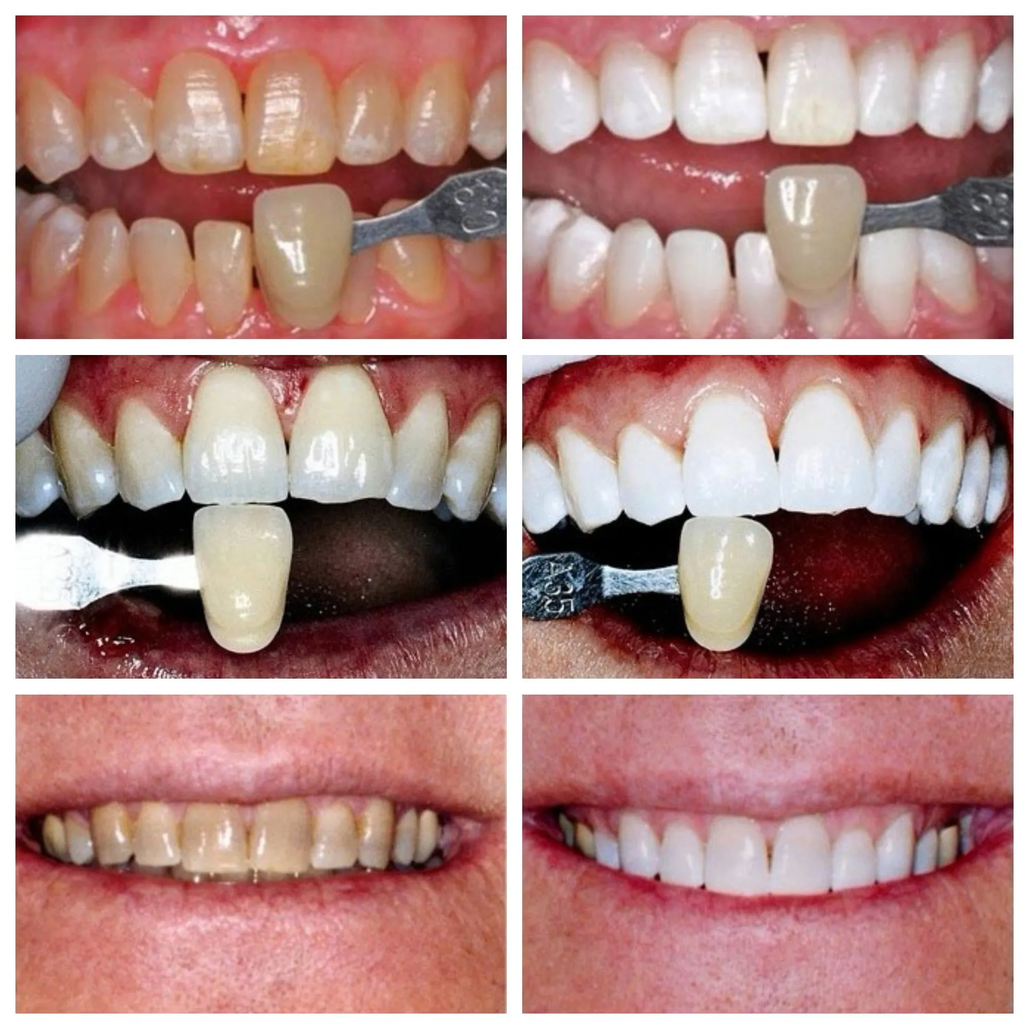30549 teeth whitening aftercare