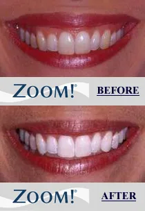 30551 professional teeth whitening