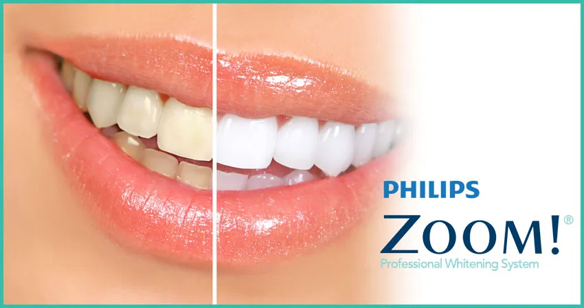 30551 teeth whitening maintenance