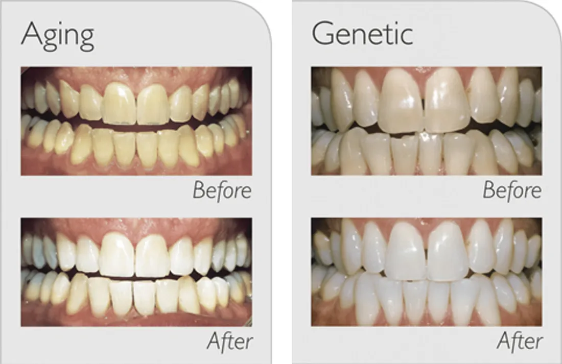 30551 zoom whitening process