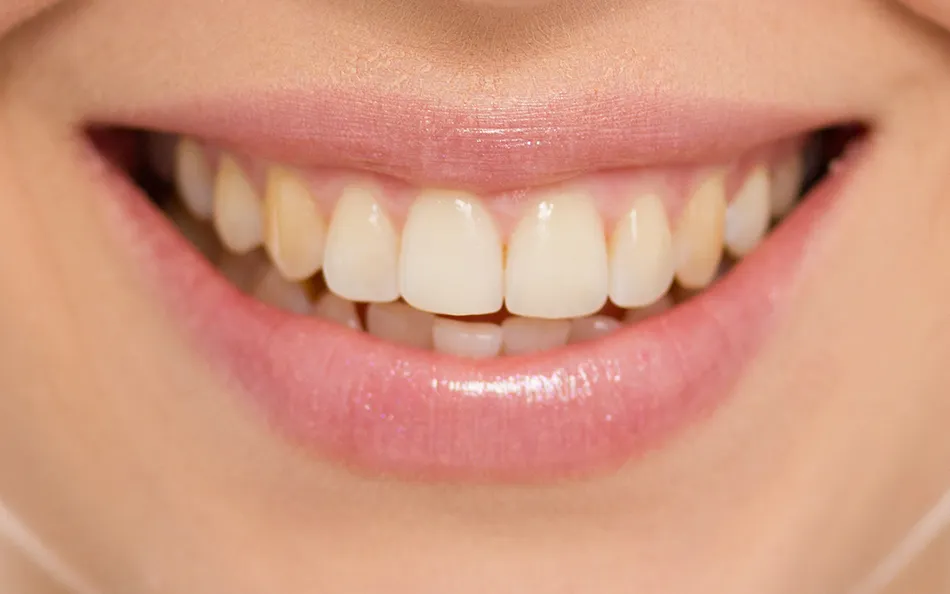 30554 teeth whitening brandon fl 5