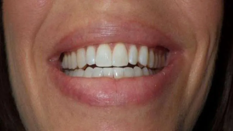 /img/30554-teeth-whitening-brandon-fl-7.webp