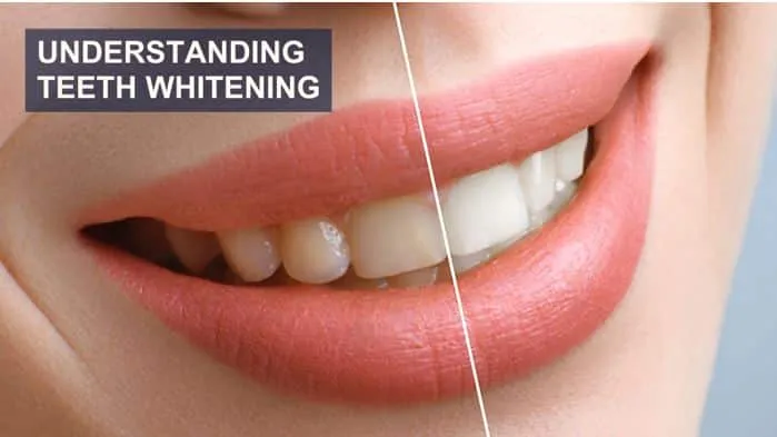 30559 post whitening care