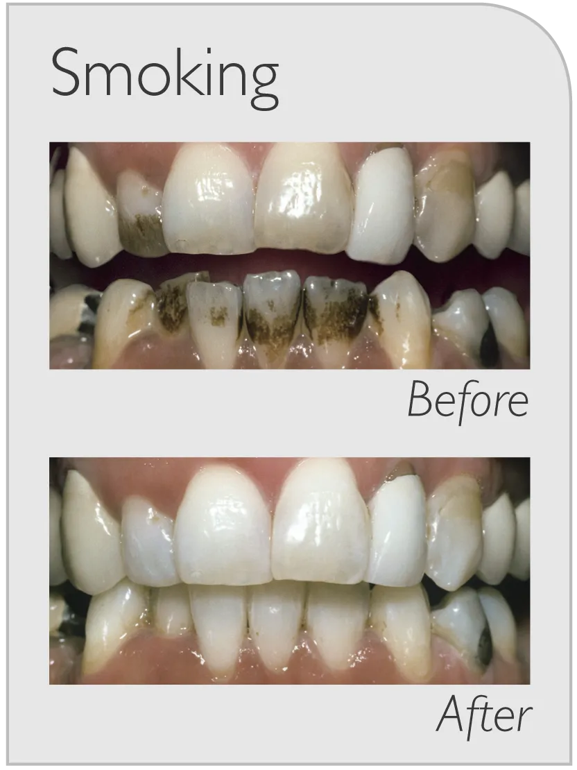 30559 smoking habits