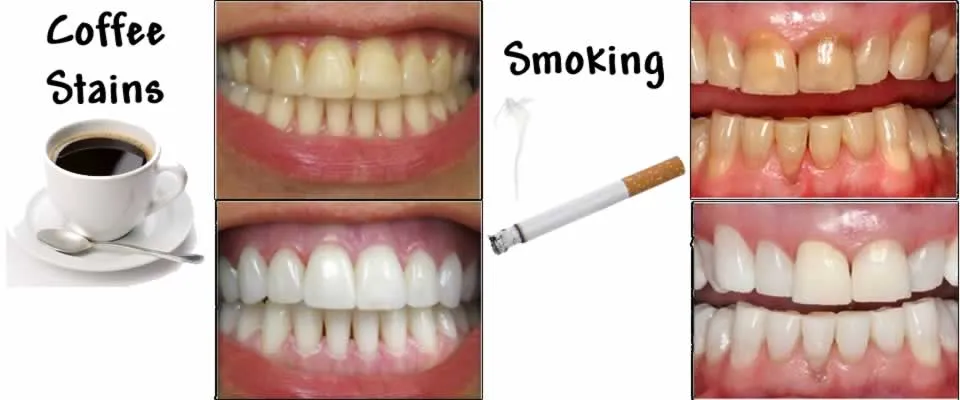 30559 teeth whitening smoke
