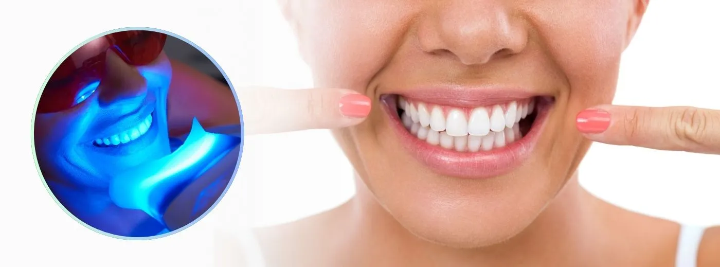 30562 at home teeth whitening