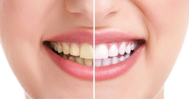 /img/30563-teeth-whitening-deals.webp